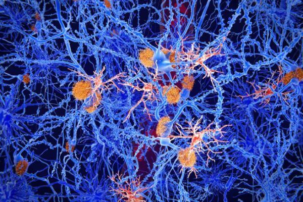 Alzheimer: Protein Kibra Could Reverse Memory Problems- Corriere.it